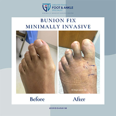 minimally invasive bunion and hammertoe correction before and after