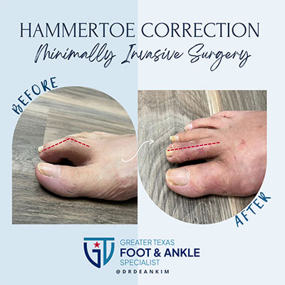 minimally invasive bunion and hammertoe correction before and after