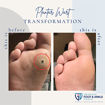 swift microwave plantar wart therapy before and after