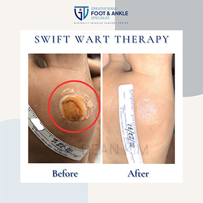 swift microwave plantar wart therapy before and after